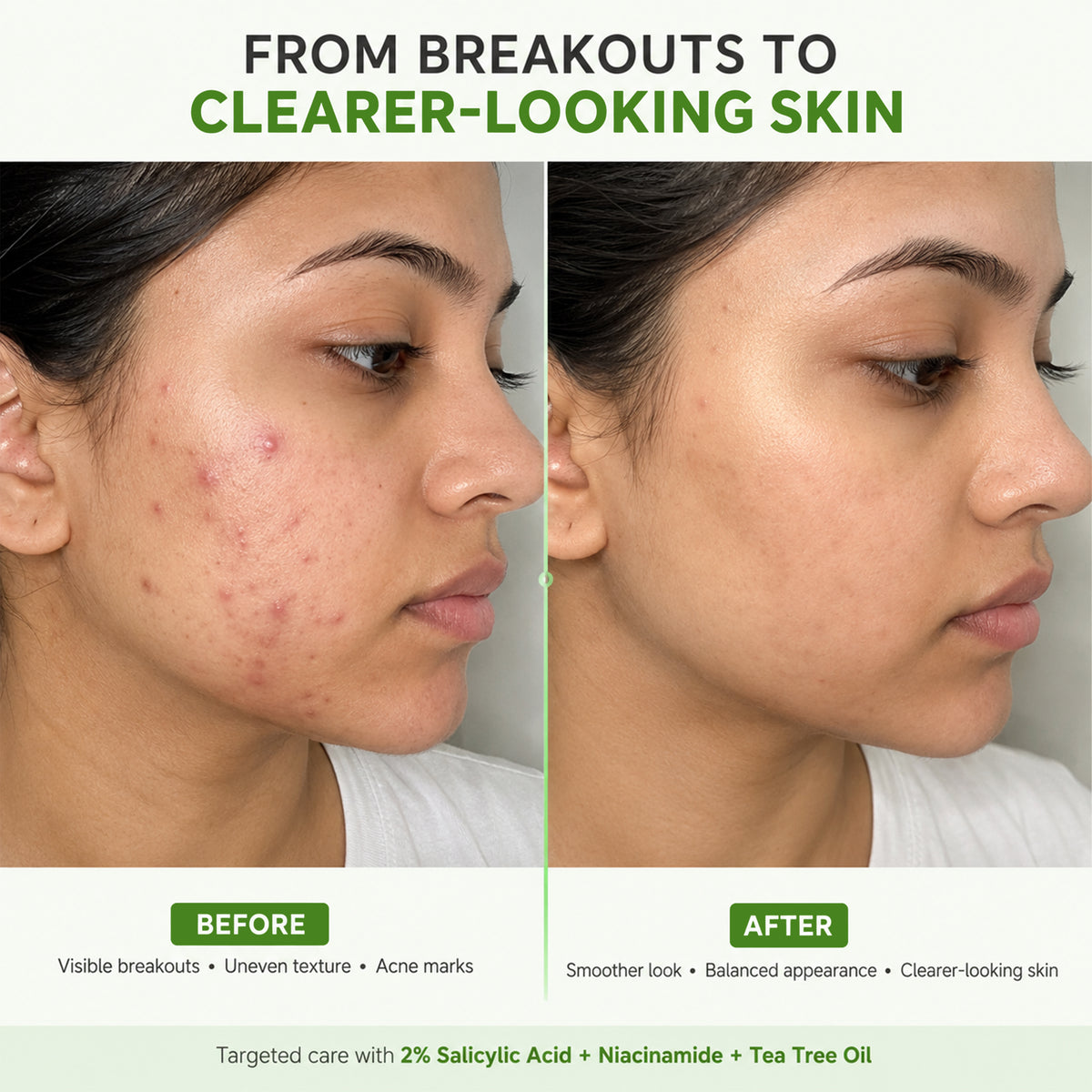 Tea Tree Oil + 10% Niacinamide Anti-Acne Serum – 30ml