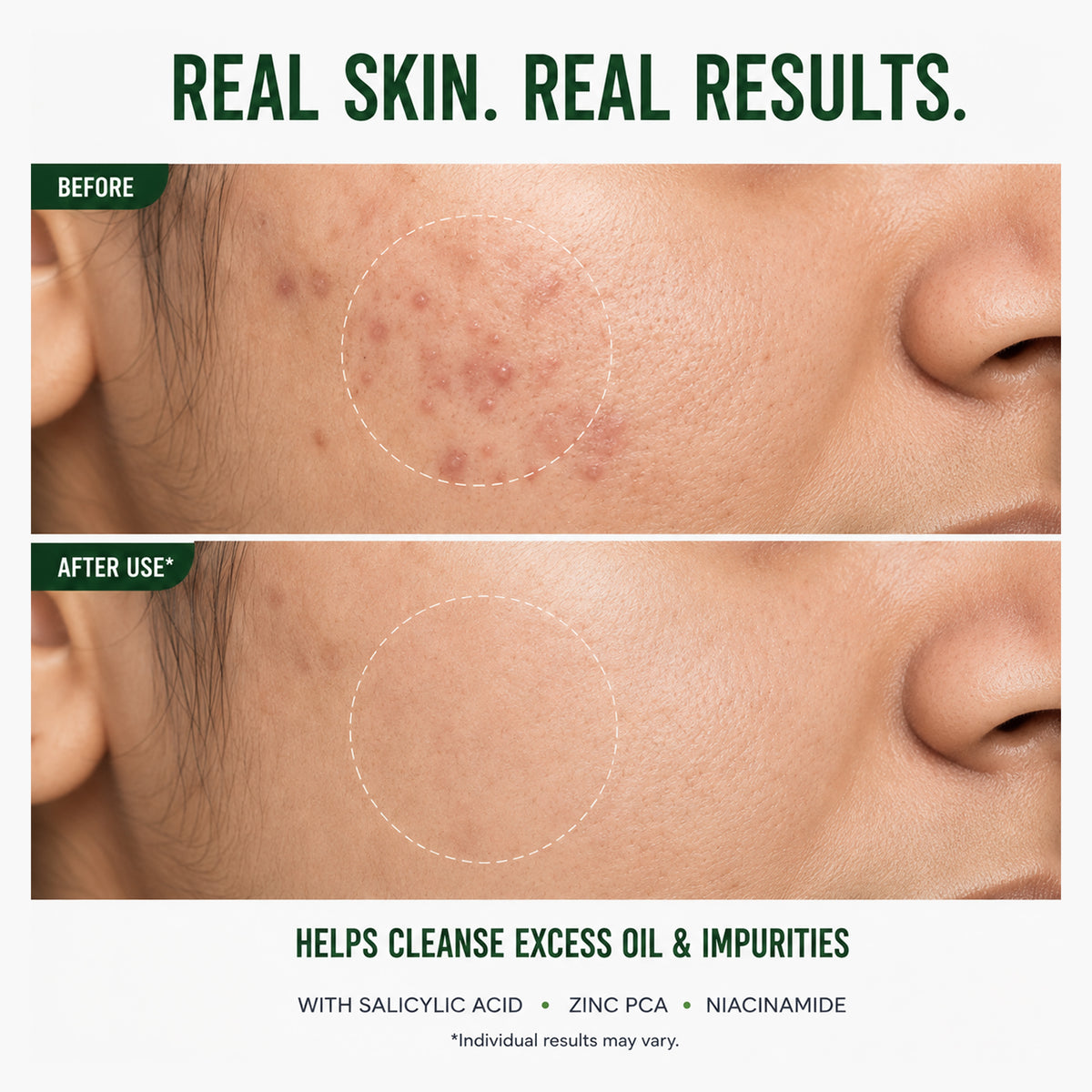 Anti-Acne Face Wash - 100 ml